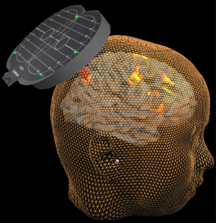 Bridging the gap between scientific research and clinical practice in the field of non-invasive brain stimulation (TMS and TES) | Neuromodec news